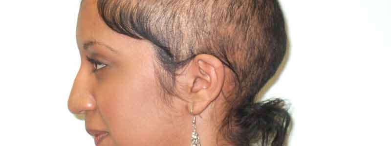 Causes of Hair loss in Females